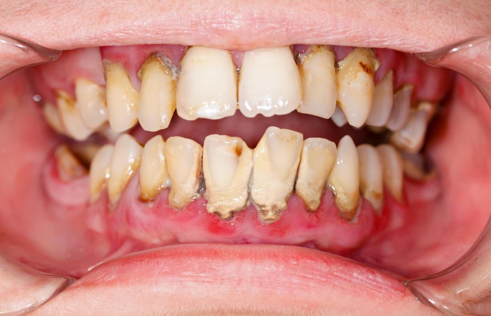 Some evidence suggests that maltitol can minimize the chances of developing tooth decay.