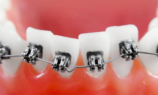 The expenses related to braces and other orthodontic work are HSA eligible.